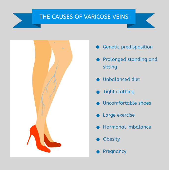 Varicose Veins: Causes, Treatment, Diagnosis, and Prevention - Elite Vein  Clinic