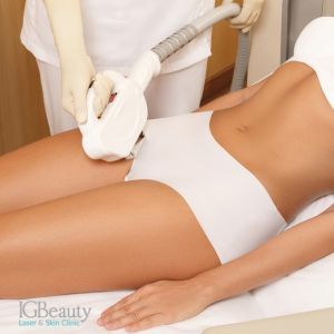 Brazilian hair clearance removal laser cost