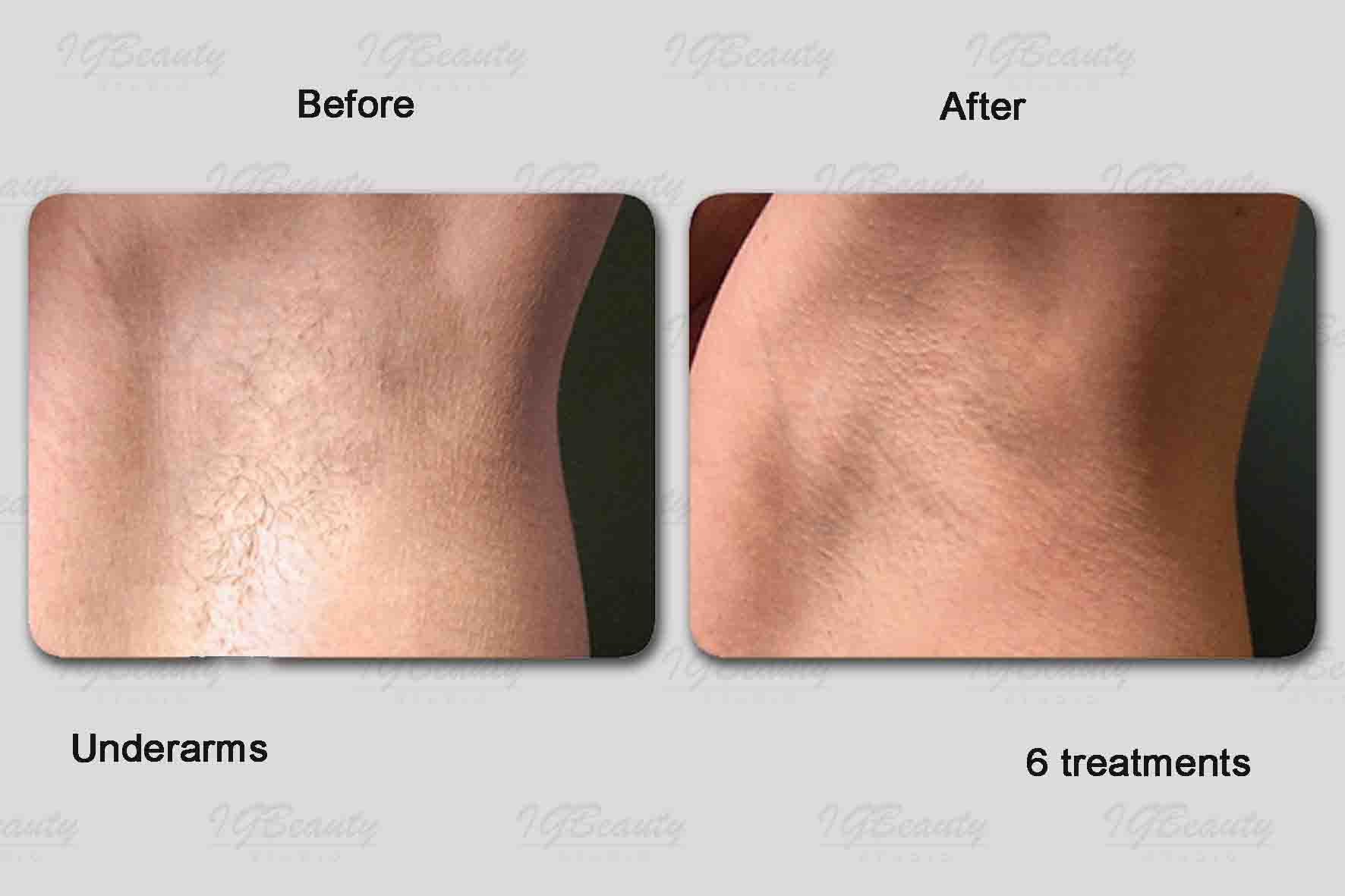 Full brazilian laser hair removal before and after photos reddit