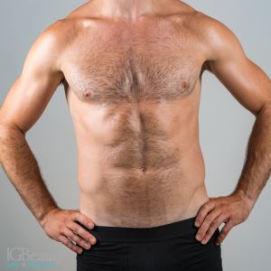 laser hair removal for men